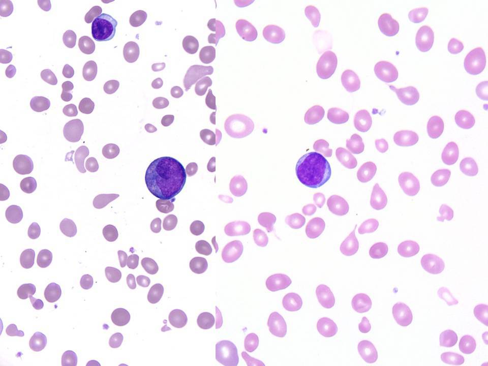 Peripheral blood - Neutrophilic left shift with promyelocyte (left) and blast (right).